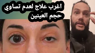 علاج : عدم تساوي حجم العينين بحيت تصبح عين اكبر من عين ؟