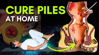 How to Shrink Hemorrhoids Naturally with Yoga: Simple Poses for Daily Relief