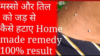 मस्सो को जड़ से कैसे हटाए || Home made remedies step by step in hindi