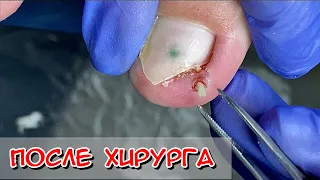 Сюрприз после хирурга /  Вросший ноготь пробил боковой валик / Удаления вросшего ногтя у хирурга