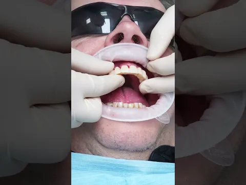Dental implant’s All on 4 in Prague #shorts #dentist #dental #implant #veneers #short