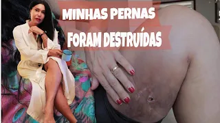 MINHA CIRUGIA DEIXOU MARCAS PARA SEMPRE ! | JOANNA MARIA, A CAPIXABA