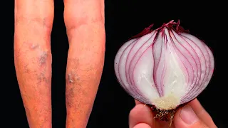 Unglaublich! 🤩 Es ist ein Krampfader Killer! Löscht Krampfadern wie ein Radiergummi! Top 3 Rezepte