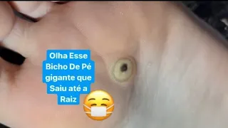 BICHO DE PÉ OLHA O TAMANHO DO OLHO DELE 😱 A Little Foot Bug😷Podologo Maurelio