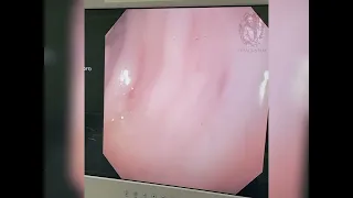 INTUSUSCEPCIÓN