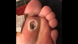 i shouldn't HAVE popped it...