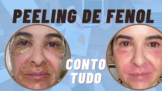 Fiz peeling de fenol de croton e conto tudo
