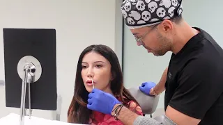 My Lip Lift With Dr. Mascaro and Recovery Vlog
