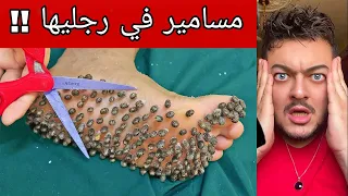 وضعت مسامير في رجليها ! ^ خيال ^  🤕🤕