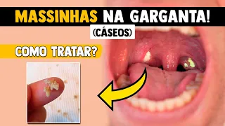 Massinhas fedidas na garganta (Caseo Amigdaliano): Como se livrar?