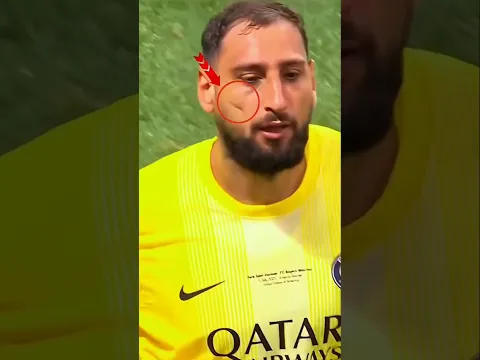 😳 السر الحقيقي وراء ندبة دوناروما