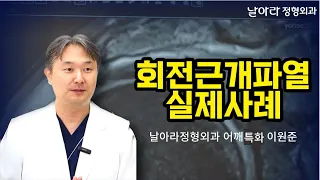 어깨 회전근개파열 실제 치료사례 [날아라정형외과 어깨수술중점 이원준]
