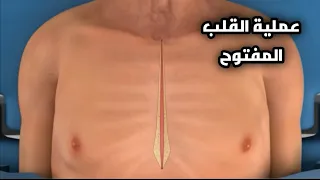 شاهد عملية القلب المفتوح ولأول مرة بتقنية 3D مع الاسباب وطريقة الإجراء #صحة#ترند#اكسبلور