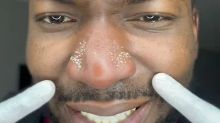 Removing Oil and blackheads in my Nose after 2 months.