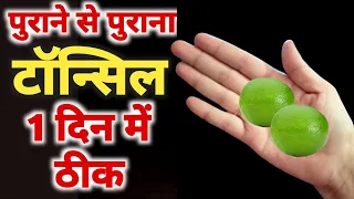 पुराने से पुराने टॉन्सिल का घरेलु उपाय, एक दिन में पुराण टॉन्सिल बिलकुल ठीक / Tonsils Remedy