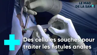 La greffe de cellules souches pour réparer les fistules anales - Le Magazine de la Santé
