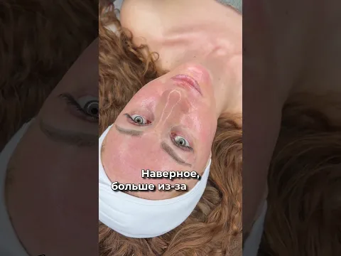 Микронидлинг! Процесс процедуры! #вильнюскосметолог