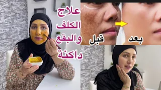فقرة الجمالي❤️أقسم بالله علاج الکلف والبقع داکنة في الوجه ونتيجة مضمونة من أول استعمال