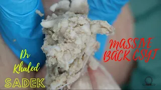 Massive Cyst Content and Sac. Dr Khaled Sadek . LipomaCyst.com