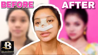 MY RHINOPLASTY JOURNEY PART 2 | ELLE QUIÑONES