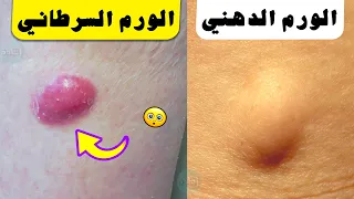 الفرق بين الورم الدهني والورم السرطاني ؟