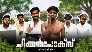 ചിക്കൻപോക്സ് 🥵🤒 | comedy short sketch 