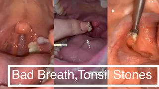 Bad breath,Tonsil Stones,Compilation Videos