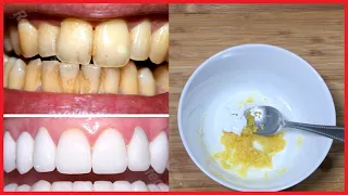 Blanqueamiento dental en casa en 3 minutos /Cómo blanquear tus dientes amarillos de forma natural a