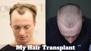 I Got a Hair Transplant in Turkey!