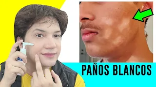 COMO QUITAR MANCHAS BLANCAS DE LA CARA | Remedios caseros | ELIMINAR PAÑOS BLANCOS | Andy Zaturno