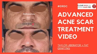 Acne Scars Treatment in Pune - Taylor Liberator + Fat Grafting | Procedure Video | Clear Skin Clinic