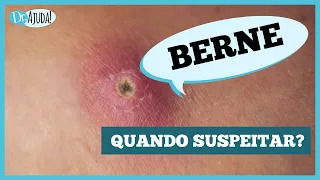 BERNE: larva sob a pele, dor e inflamação
