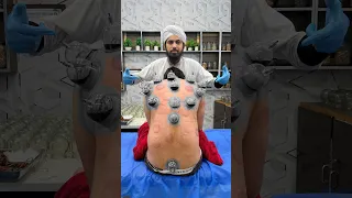 Hijama Cupping Therapy Benefits | What Happens During a Hijama Session in Lahore | Dr Usman Faiz