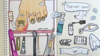 [🚀paper diy] Ingrown toenail removal 내성발톱 제거하기 ASMR 🔇No music 종이놀이 paper play
