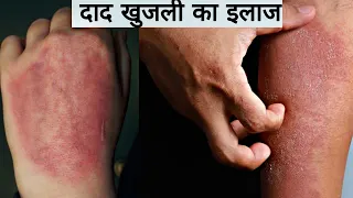 दाद खाज खुजली की 2 दिन में छुट्टी कर देगा Fungal Infection Treatment at Home / Daad Khaj Khujli
