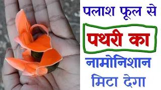 पलाश का एक फूल से पाए पथरी की बीमारी से राहत// 1 खुराक में पथरी होगा जड़ से खत्म