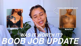 So... My Boob Job Wasn’t Perfect