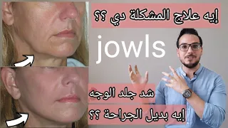 علاج تهدل جلد الوجه للأسفل / رفع الخدود ؟ طرق شد جلد الوجه ؟ ايه بديل الجراحة ؟