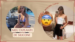 Meu explante de silicone,  como foi - MOSTREI O DEPOIS! - resultado biópsia! -RENATA MEINS