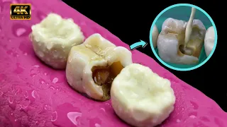 INCREIBLE caries entre los dientes tratamiento : Endodoncia + Resina compueta 4k