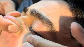 Secret Acne treatment and ASMR Barber Massage