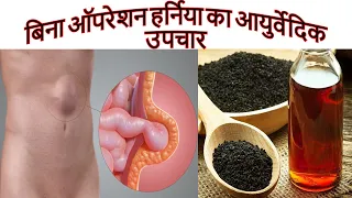 बिना दवाई और ऑपरेशन के हर्निया का आयुर्वेदिक उपचार | Ayurvedic Hernia Treatment