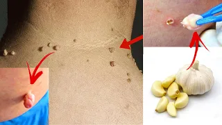 तिल और मस्से को 5 MINUTE में जड़ से ख़त्म करने का सबसे अच्छा उपाय - Remove Skin Tag Naturally
