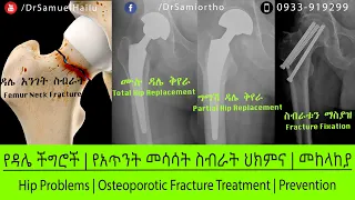 ኢትዮጵያ: ዳሌ መገጣጠሚያ ችግሮች | የአጥንት መሳሳት ዳሌ አንገት ስብራት  ህክምና   | መከላከያ - ዶ/ር ሳሚ ኃይሉ