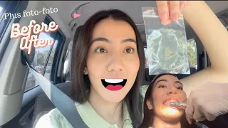 Akhirnya lepas behel , sambil mini vlog.