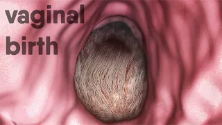 Vaginal-Birth, Natural -Childbirth