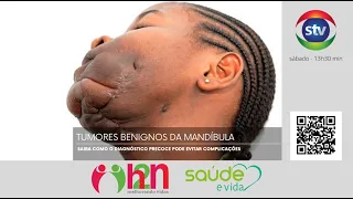 h2nmoz - Saúde e Vida: tumores benignos da mandíbula