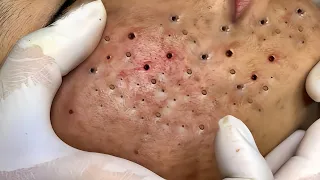 Deep Blackheads Removal from Cheeks and Nose | Best Pimple Popping Video 