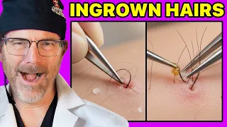 Plastic Surgeon Reacts to SATISFYING Ingrown Hair Pulls