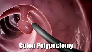Removing a polyp from the colon (3D Animation)